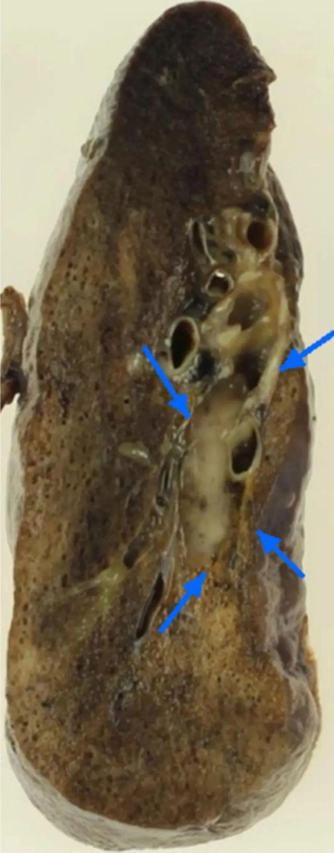肺凡案例非吸烟者体检发现罕见肺癌？这种特殊类型如何早期识别？(图2)